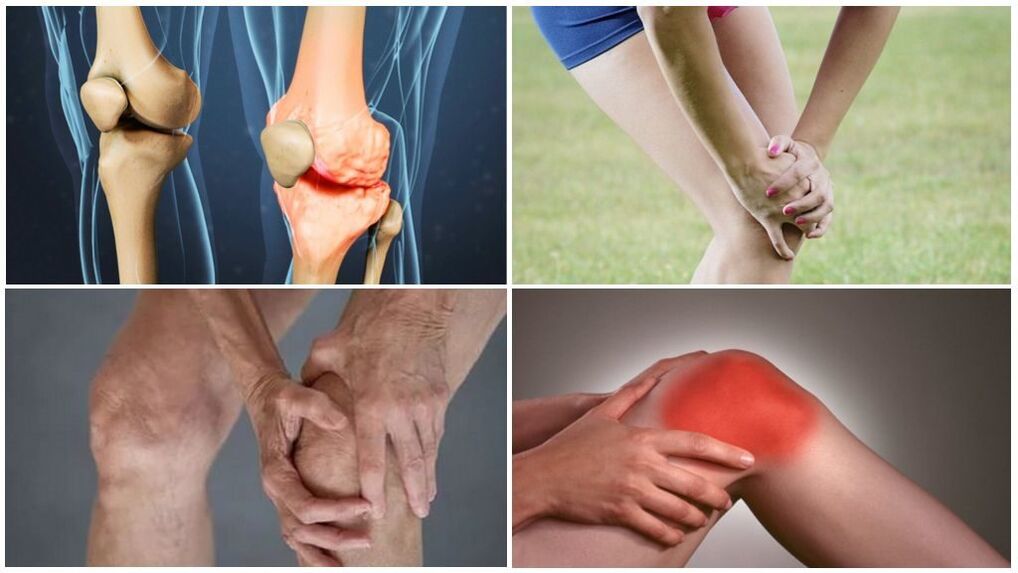 Stades d'arthrose
