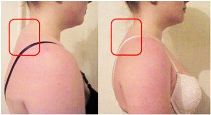 Formation de rouleaux musculaires avec ostéochondrose cervicale