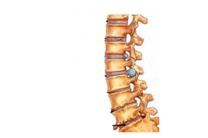 Dommage à la colonne vertébrale avec une ostéochondose cervicale