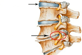 Épine normale et endommagée avec ostéochondose cervicale