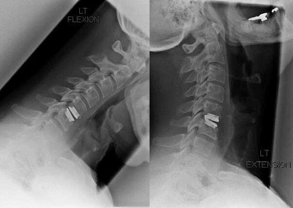 Image de la colonne vertébrale après la chirurgie