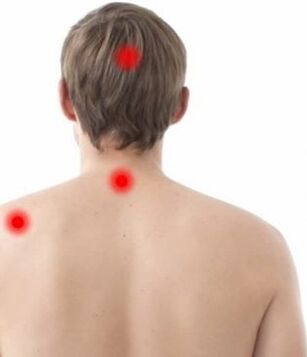 Localisation de la douleur dans l'ostéochondrose cervicale